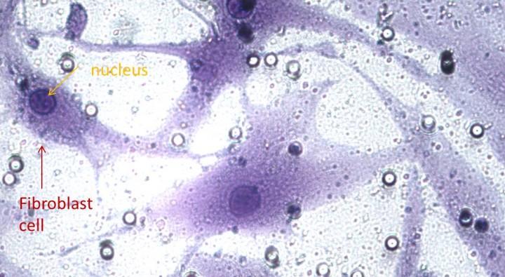 A snapshot of Emma's research: rheumatoid arthritis synovial fibroblasts that have invaded through an experimental chamber.